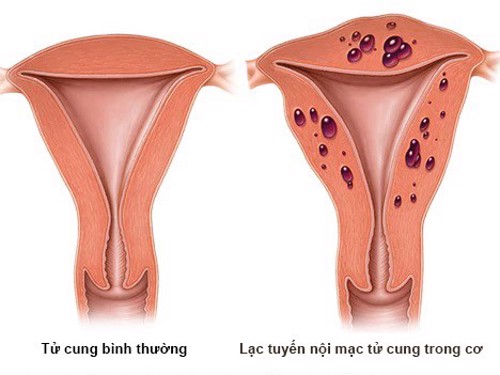 Nhóm chị em có nguy cơ bị lạc nội mạc tử cung